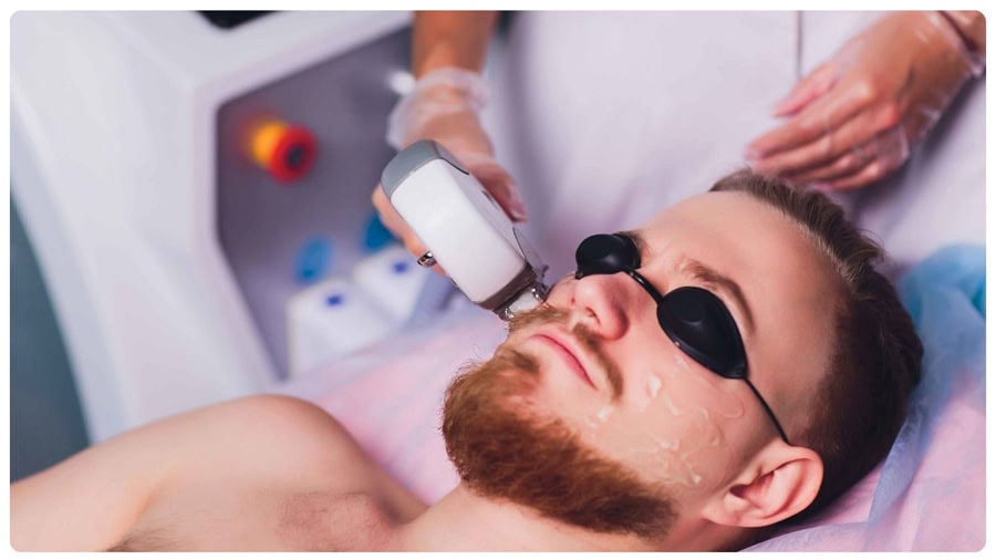 Phương pháp triệt râu bằng Laser được nhiều người lựa chọn