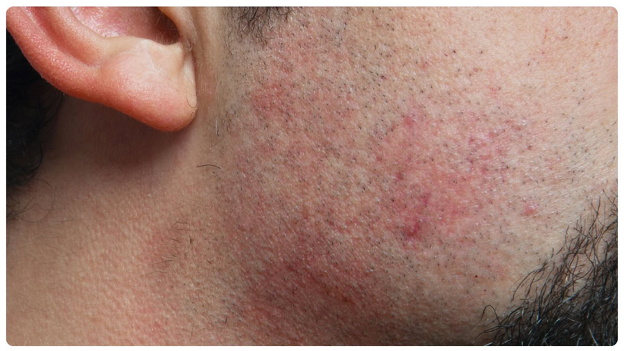 Sau triệt râu da có thể ửng đỏ trong thời gian ngắn