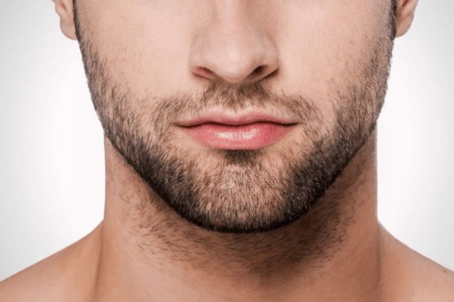 Triệt râu quai nón: Phương pháp, chi phí và lưu ý quan trọng 2 Triệt râu quai nón ngày càng phổ biến