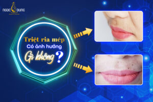 Có nên triệt ria mép không? Triệt ria mép có ảnh hưởng gì không?