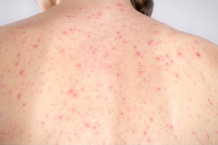 Viêm nang lông là gì? Nguyên nhân, dấu hiệu và phòng ngừa 2 Viêm nang lông khiến da nổi các vết sần sùi kém thẩm mỹ