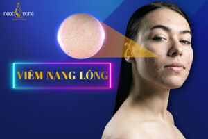 Viêm nang lông là gì? Nguyên nhân, dấu hiệu và phòng ngừa