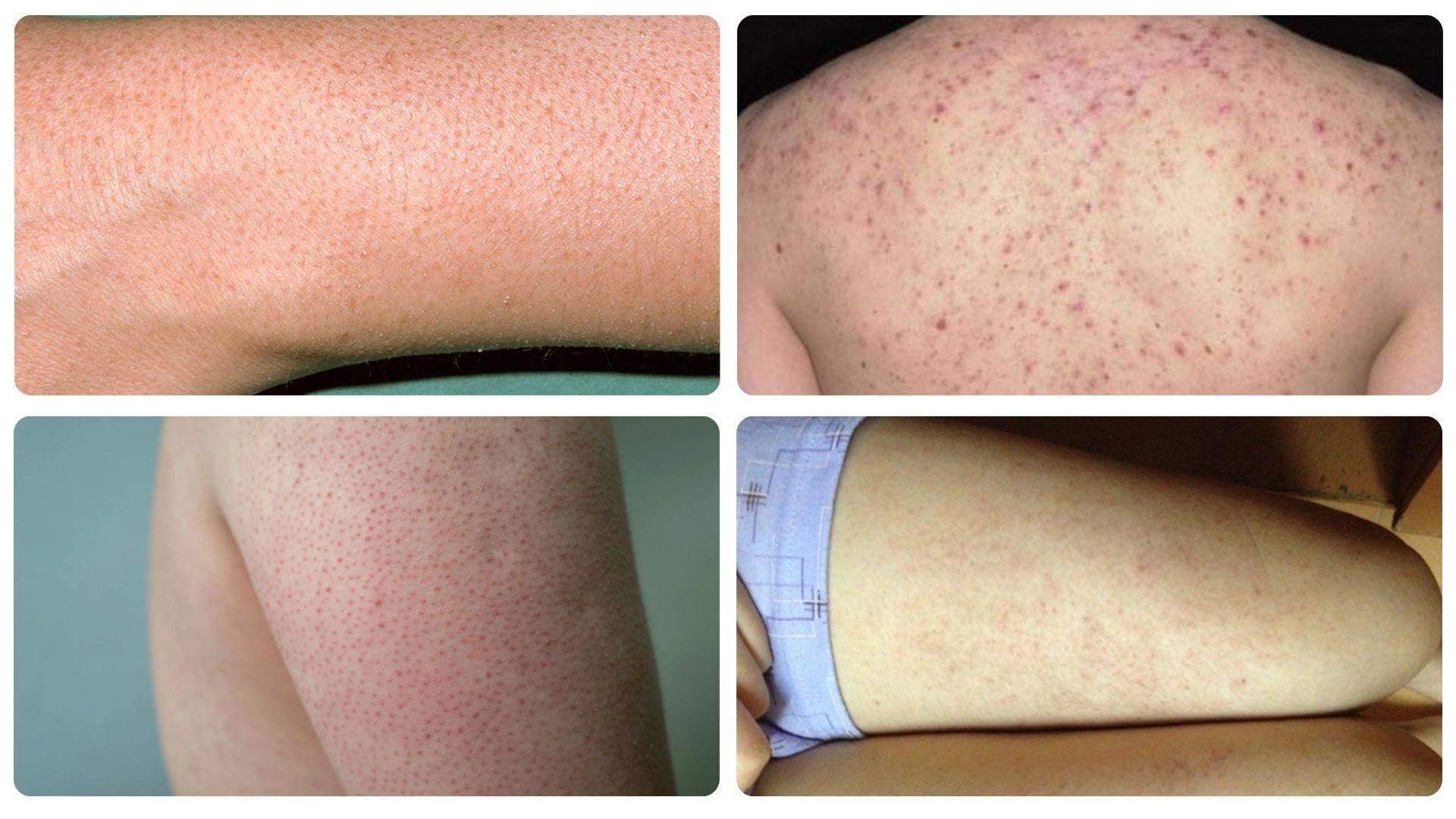 Viêm nang lông là gì? Nguyên nhân, dấu hiệu và phòng ngừa 4 Viêm nang lông thường nổi các nốt sần đỏ gây ngứa ngáy khó chịu