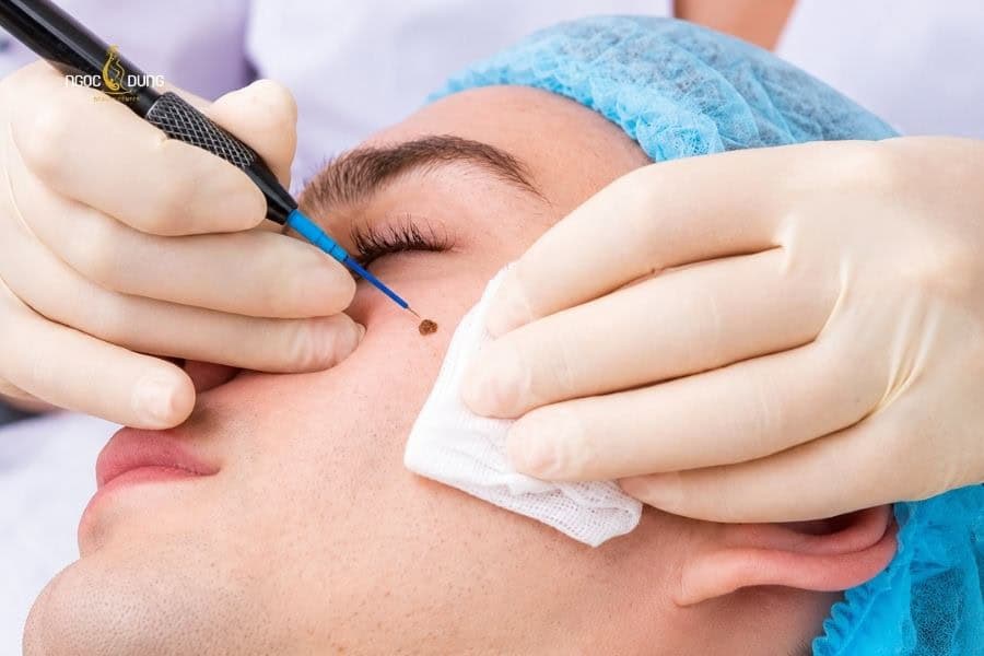 Tẩy nốt ruồi an toàn bằng laser không sẹo tại Ngọc Dung 2 Tẩy nốt ruồi với laser là giải pháp phổ biến và an toàn nhất hiện nay
