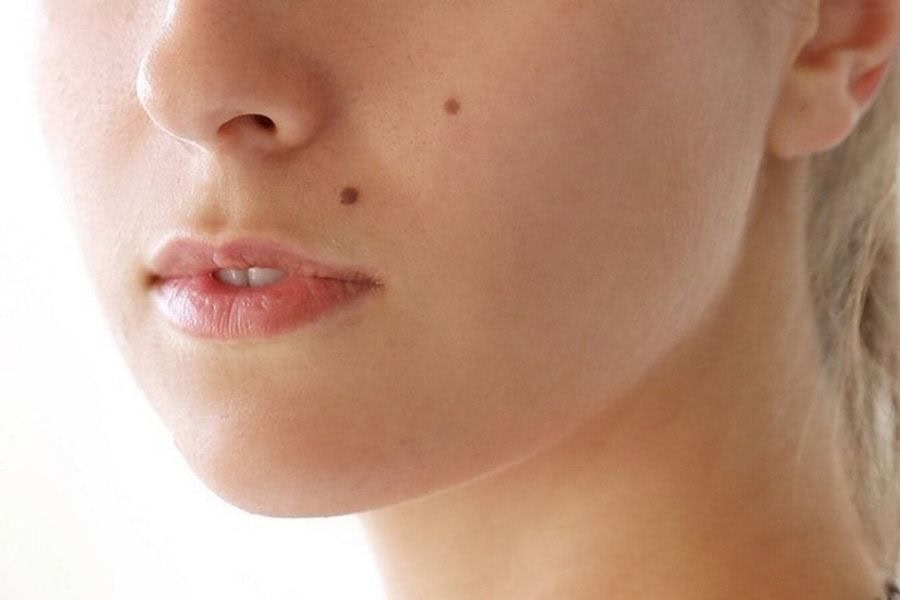 Người ta xóa nốt ruồi vì một số mọc ở vị trí không phù hợp về mặt tâm linh