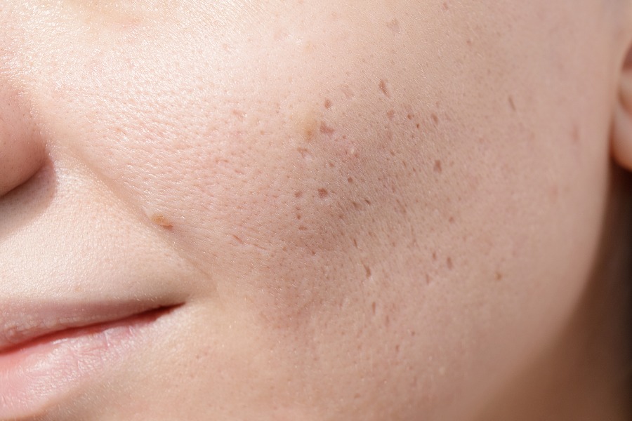 xóa sẹo lõm trên mặt lâu năm xóa sẹo lõm trên mặt lâu năm
