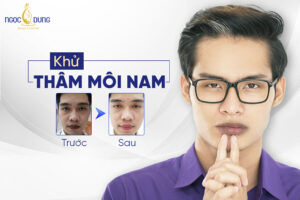9 Cách khử thâm môi nam nhanh, tự nhiên, nâng tầm phong độ