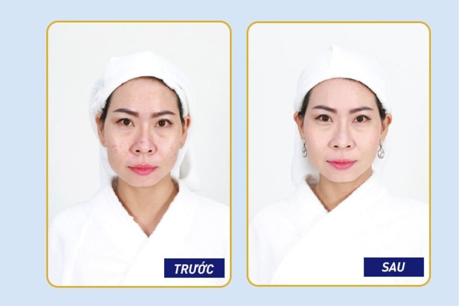 Thâm mụn mờ đi đến 90% làn da trắng sáng bật tông Thâm mụn mờ đi đến 90% làn da trắng sáng bật tông