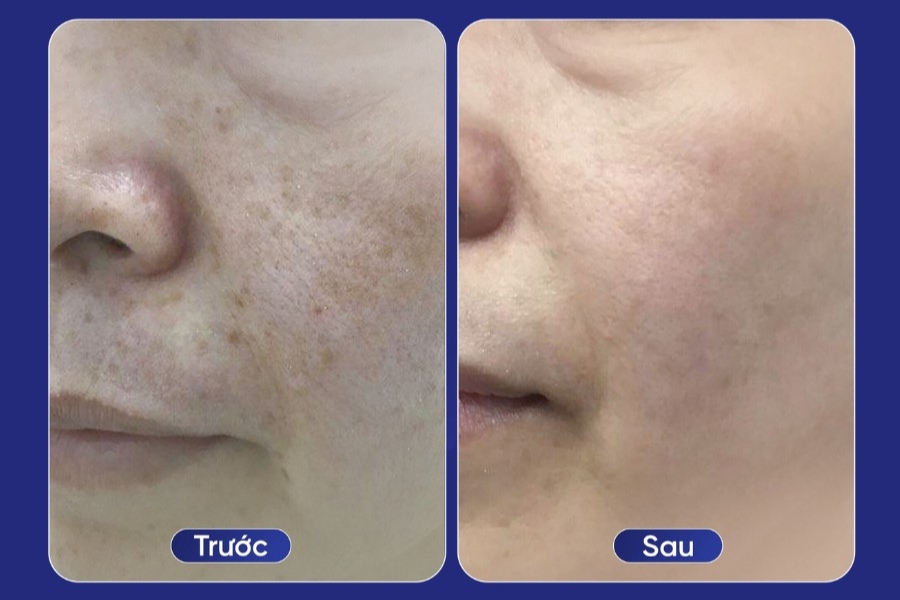 13 Cách trị thâm mụn nặng cấp tốc, an toàn nhất hiện nay 23 Kết quả sau khi điều trị thâm mụn nặng tại Ngọc Dung