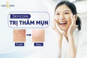 Quy trình skincare trị thâm mụn chuẩn y khoa
