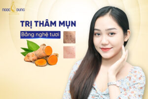 Top 13 cách trị thâm mụn bằng nghệ tươi tại nhà