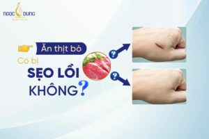 Chuyên gia giải đáp: Ăn thịt bò có bị sẹo lồi không?