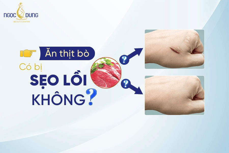 Ăn thịt bò có bị sẹo lồi không? Những giải đáp thực tế từ TMV Ngọc Dung