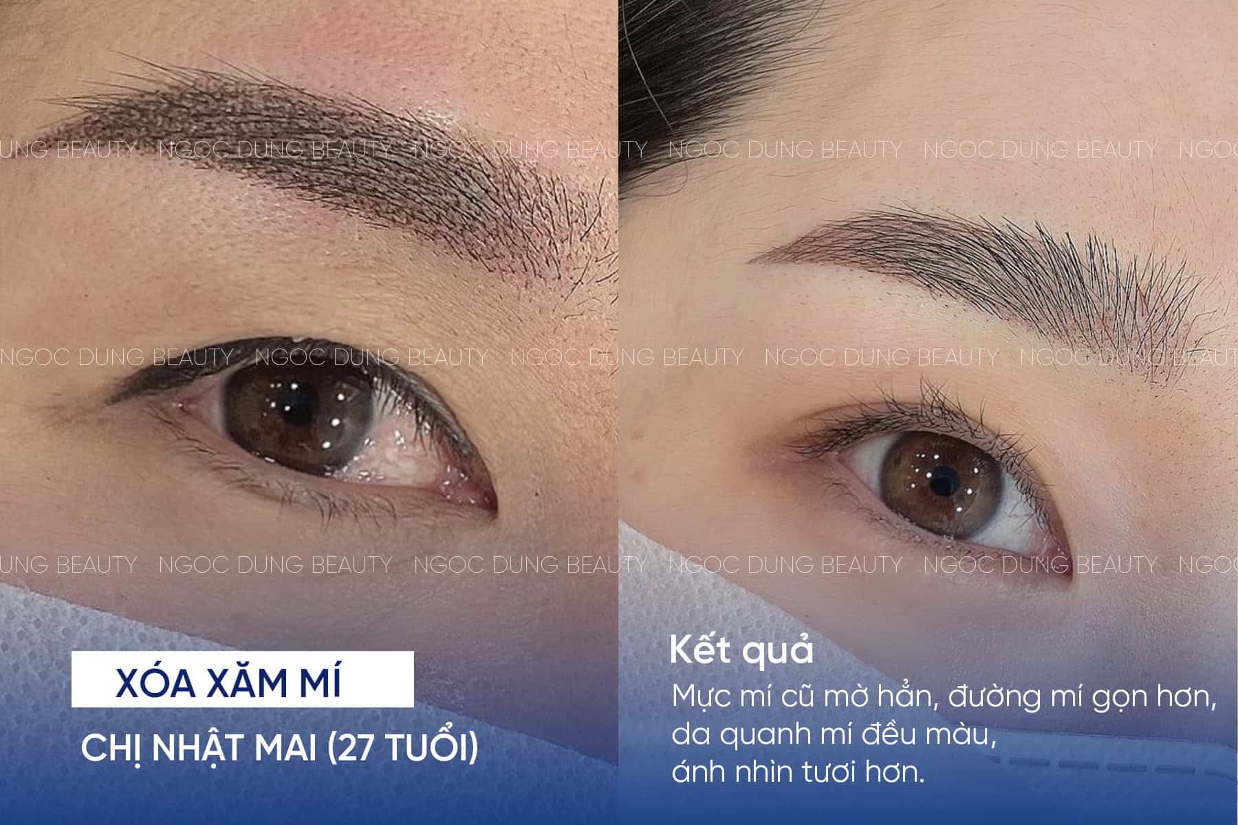 Xóa xăm mí mắt có nguy hiểm không? Những lưu ý cần biết 9 Kết quả xóa xăm mí của chị Nhật Mai