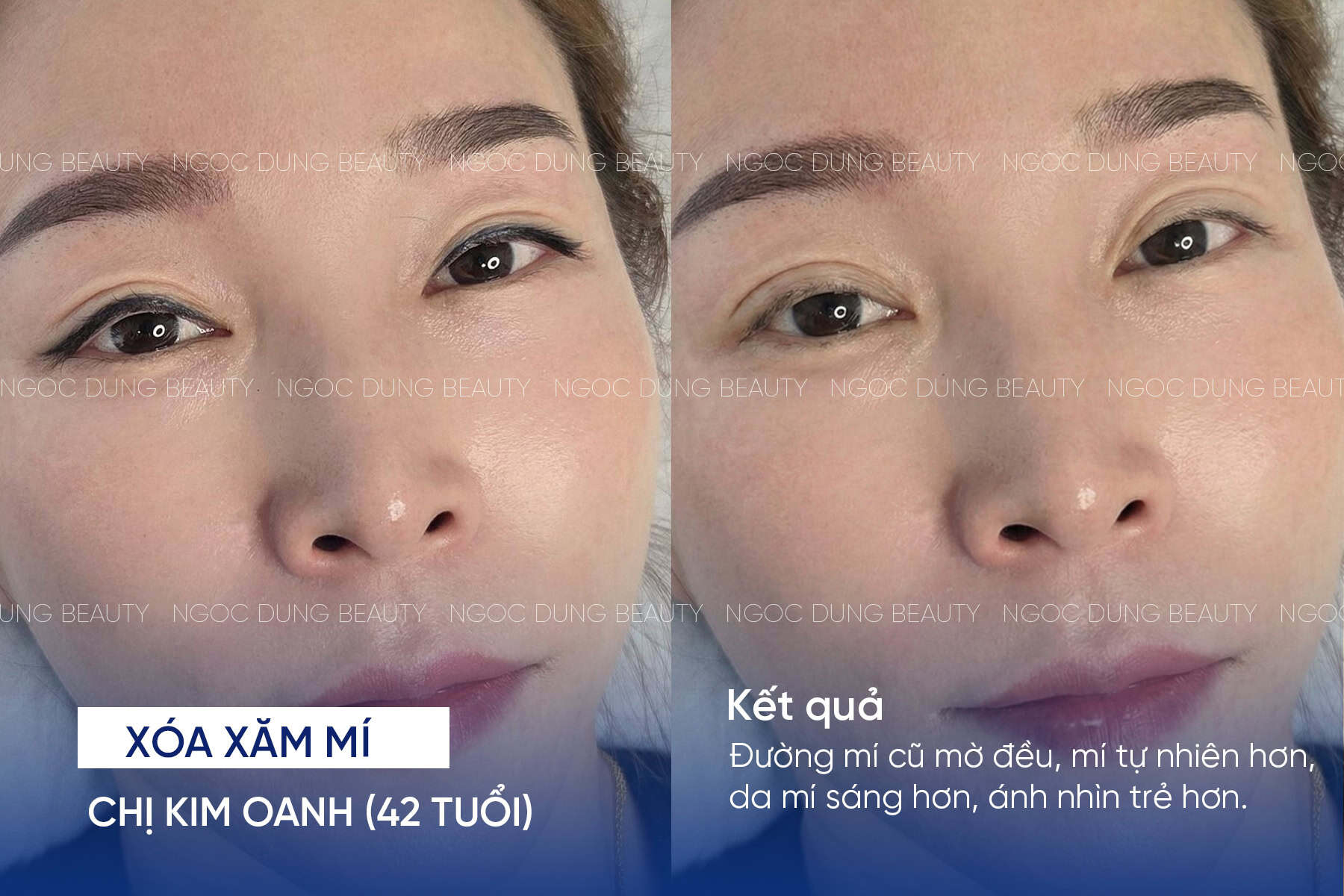 Xóa xăm mí mắt có nguy hiểm không? Những lưu ý cần biết 8 Kết quả xóa xăm mí của chị Kim Oanh