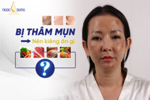 Bị thâm mụn nên kiêng ăn gì và nên ăn gì?