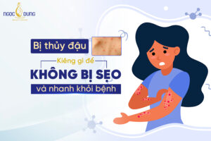 Bị thủy đậu kiêng gì để không bị sẹo và nhanh khỏi bệnh. Theo dõi ngay!