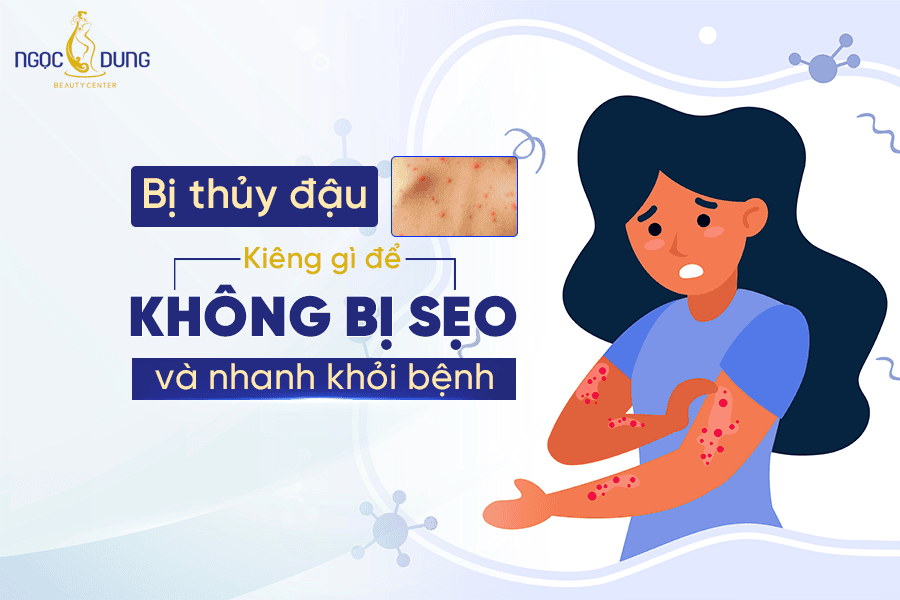 Bị thuỷ đậu nên kiêng gì để không bị sẹo và nhanh khỏi?