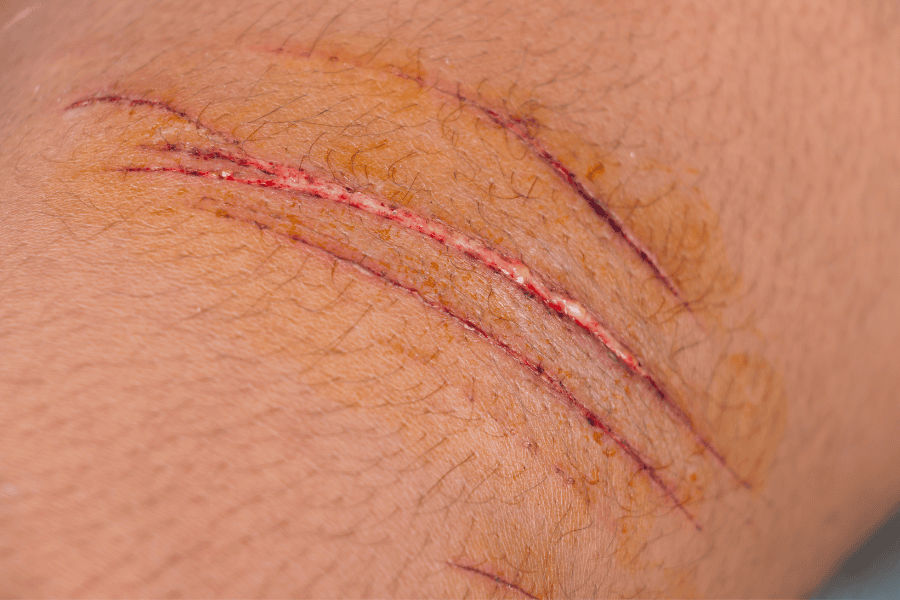 Bị vết thương hở không nên ăn thịt bò mà chờ một khoảng thời gian để lớp biểu bì tái tạo xong