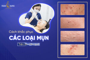Mặt mụn khiến khuôn mặt “kém xinh” và thiếu sức sống, mách bạn cách phân loại mụn cực đơn giản