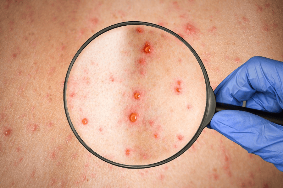 Các yếu tố ảnh hưởng trực tiếp đến thời gian mờ sẹo thủy đậu