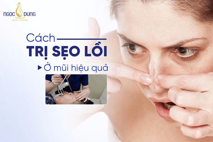 Cách điều trị sẹo lồi ở mũi hiệu quả 