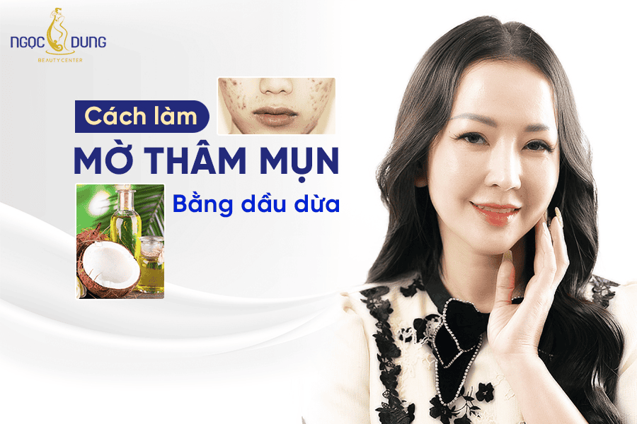 Cách làm mờ vết thâm mụn bằng dầu dừa hiệu quả tại nhà