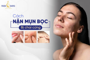 Mụn bọc bị chai là gì? Cách lấy nhân mụn bọc bị chai hiệu quả có thể bạn cần biết