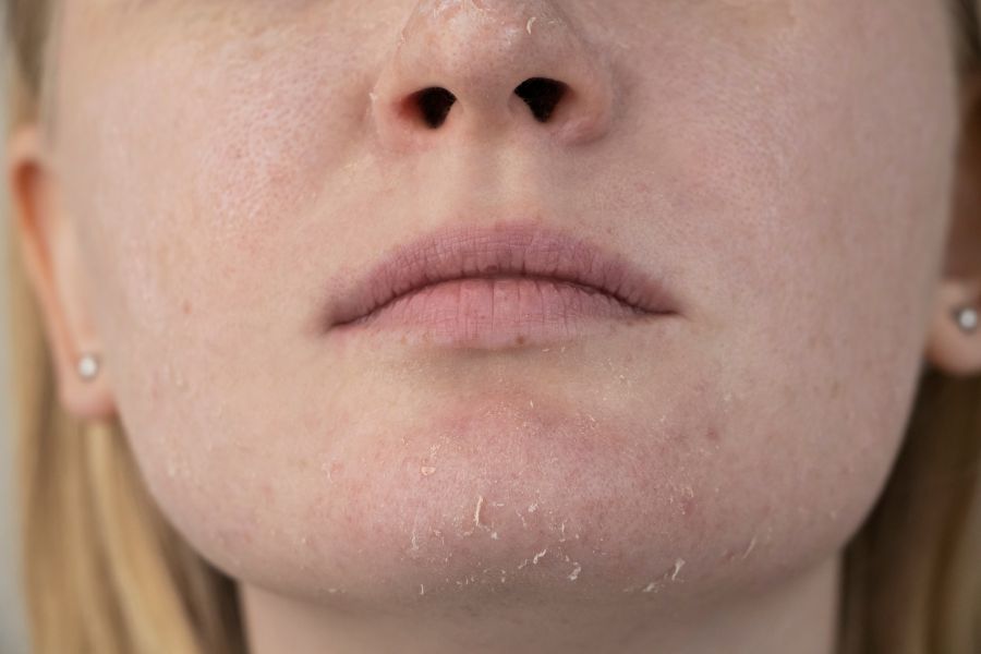 Cách nhận biết da mặt bị khô và cách chăm sóc phù hợp