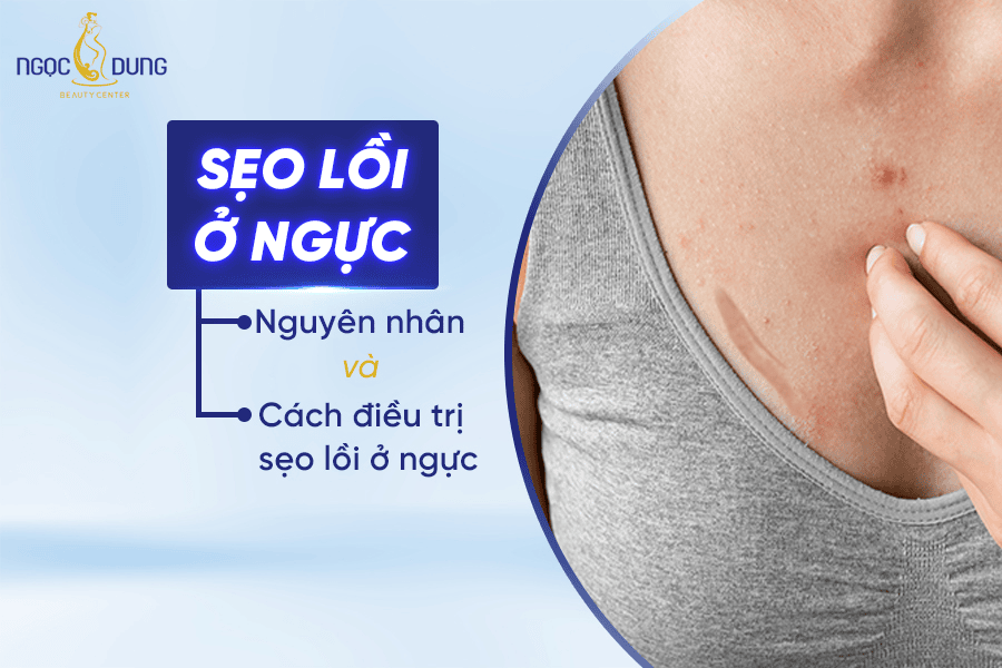 7+ Cách trị sẹo lồi ở ngực hiệu quả dứt điểm không tái phát 2 Cách trị sẹo lồi ở ngực hiệu quả dứt điểm không tái phát