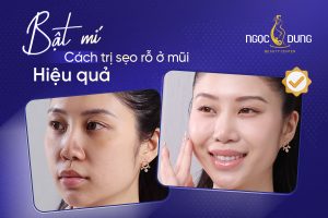 Bật mí cách trị sẹo rỗ ở mũi hiệu quả