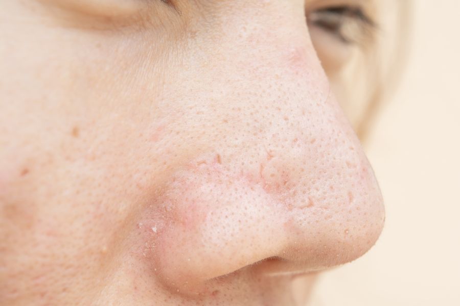 Sẹo rỗ ở mũi thường có bề mặt lõm đặc trưng
