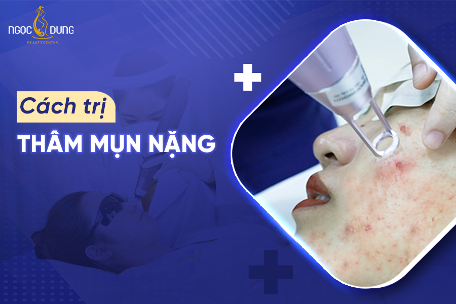 Cách trị thâm mụn nặng nào tốt nhất? Cách trị thâm mụn nặng nào tốt nhất?