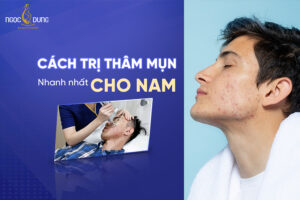 Chia sẻ các cách trị thâm mụn nhanh nhất cho nam