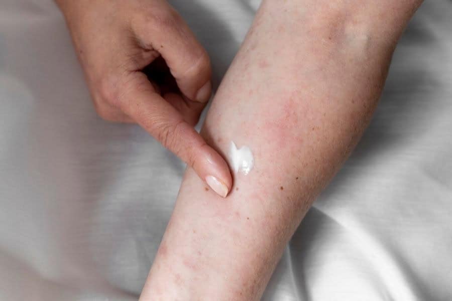 Cạo lông chân dễ gây kích ứng da nếu thực hiện không đúng kỹ thuật