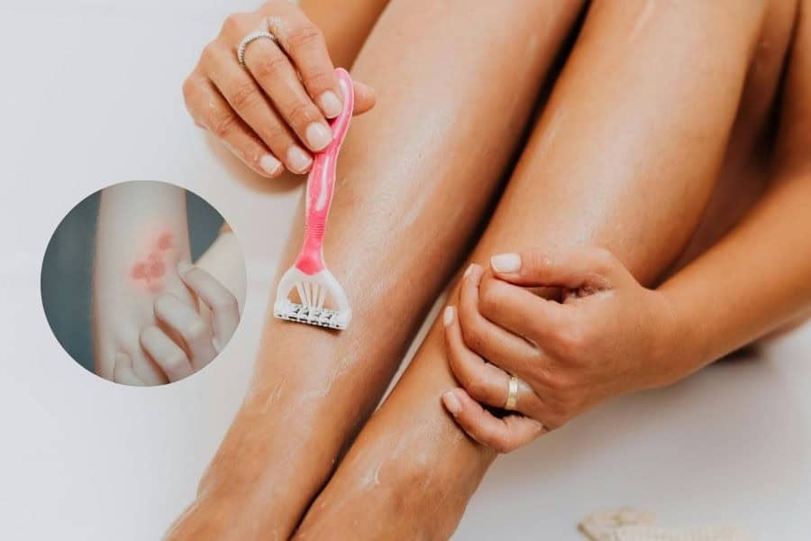 Sau khi triệt lông nên kiêng gì để đạt hiệu quả tối đa? 12 Cạo lông sau triệt có thể gây kích ứng da