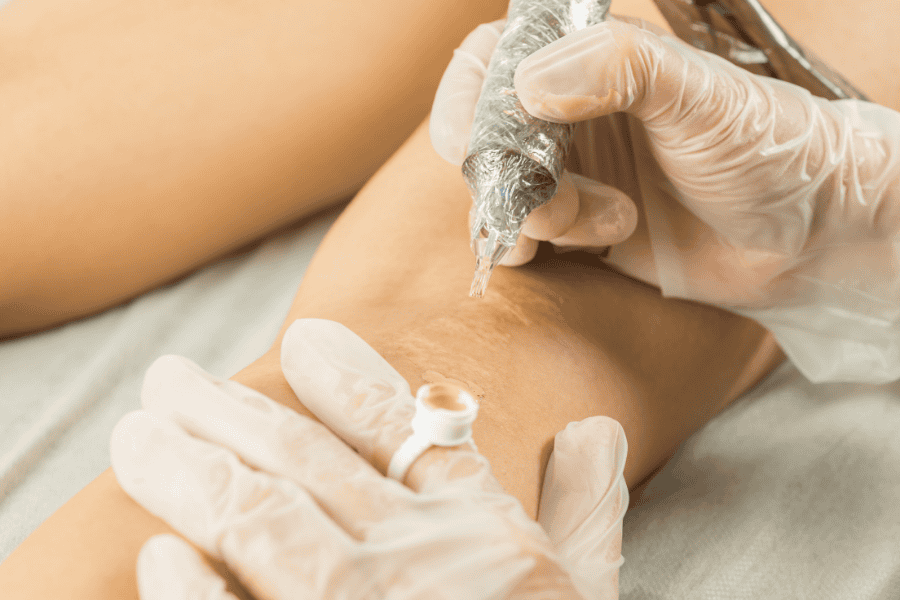 Cắt đáy sẹo giúp kích thích cơ chế tăng sinh Collagen và Elastin tự nhiên
