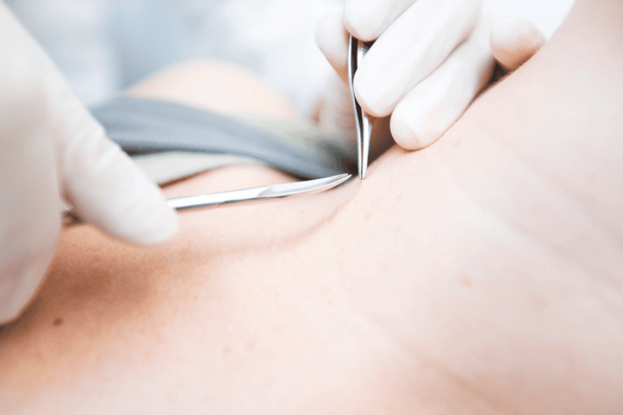 Việc trị mụn thịt bằng cắt bỏ cần được thực hiện tại cơ sở chuyên khoa để đảm bảo an toàn.