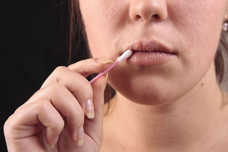 Chăm sóc đúng cách trong 3–5 ngày đầu thường giúp mụn nước khô dần và biến mất mà không để lại biến chứng