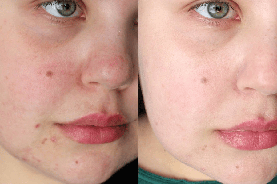 Công nghệ IPL là gì? Công dụng và quy trình điều trị da 5 Công nghệ IPL giúp điều trị các loại mụn trứng cá và thâm mụn hiệu quả