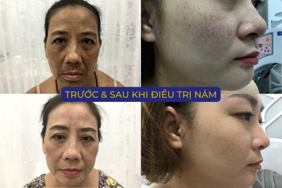 Trước và sau khi điều trị nám tại TMV Ngọc Dung