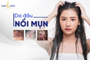 Da đầu nổi mụn là do đâu?