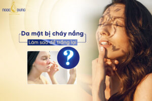 Da mặt bị cháy nắng làm sao để trắng lại? 8 Cách phục hồi da