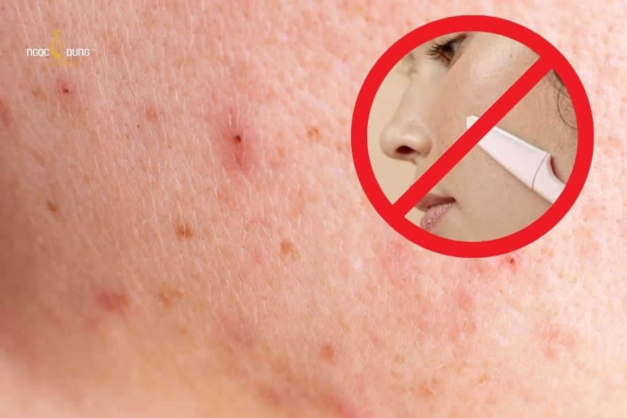 Không nên cạo lông mặt khi da đang bị mụn
