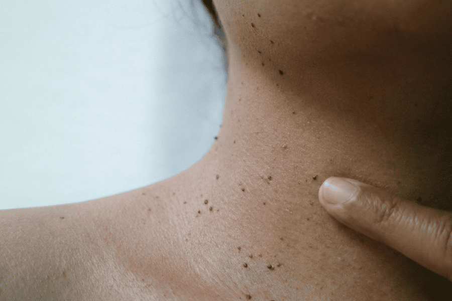 Yếu tố cơ địa là nguyên nhân phổ biến gây ra mụn thịt