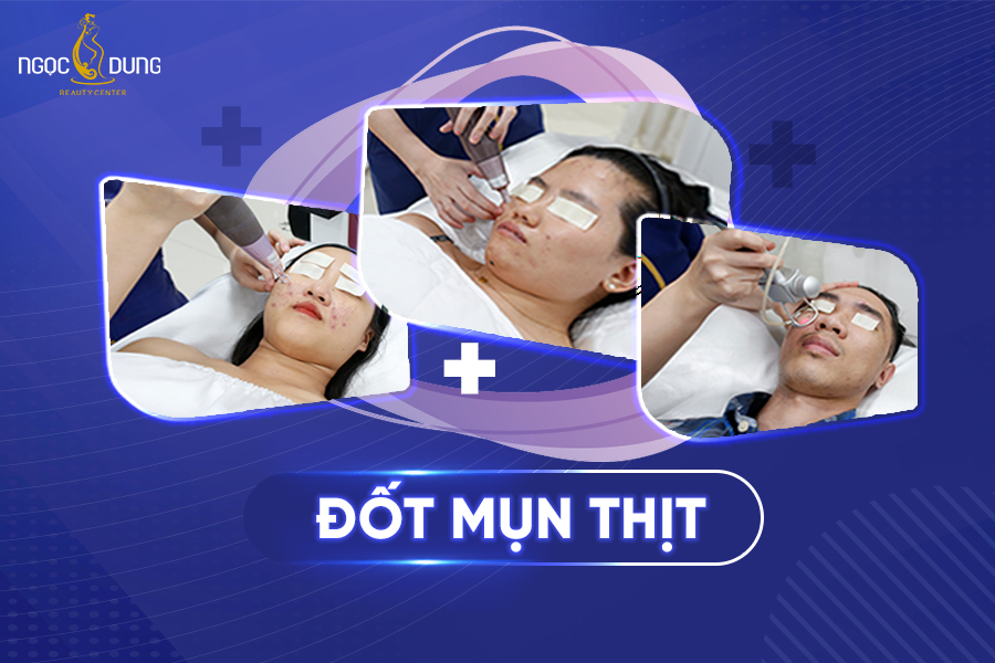 Đốt mụn thịt có tốt hay không?