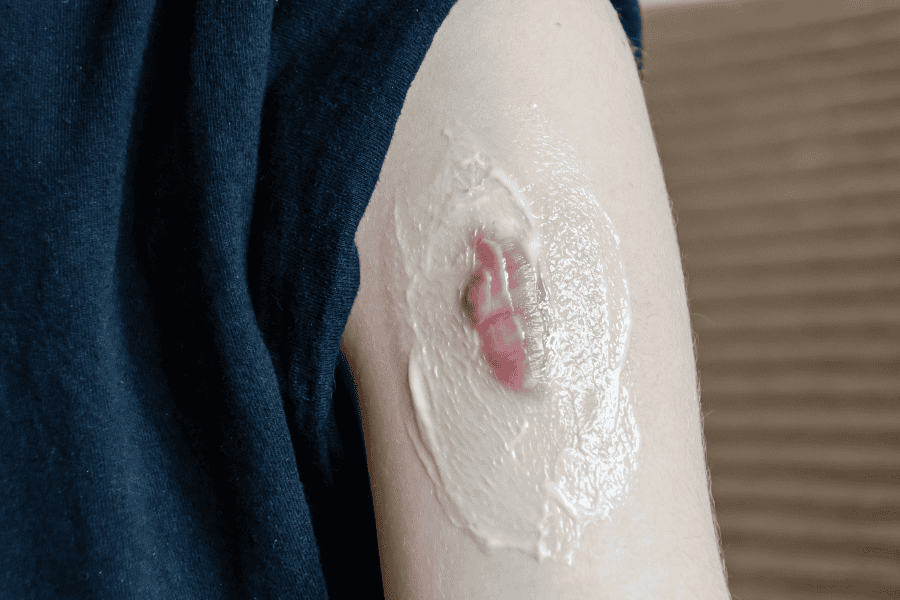 Dưỡng ẩm đều đặn mỗi ngày giúp duy trì hàng rào bảo vệ da, làm mềm mô sẹo 