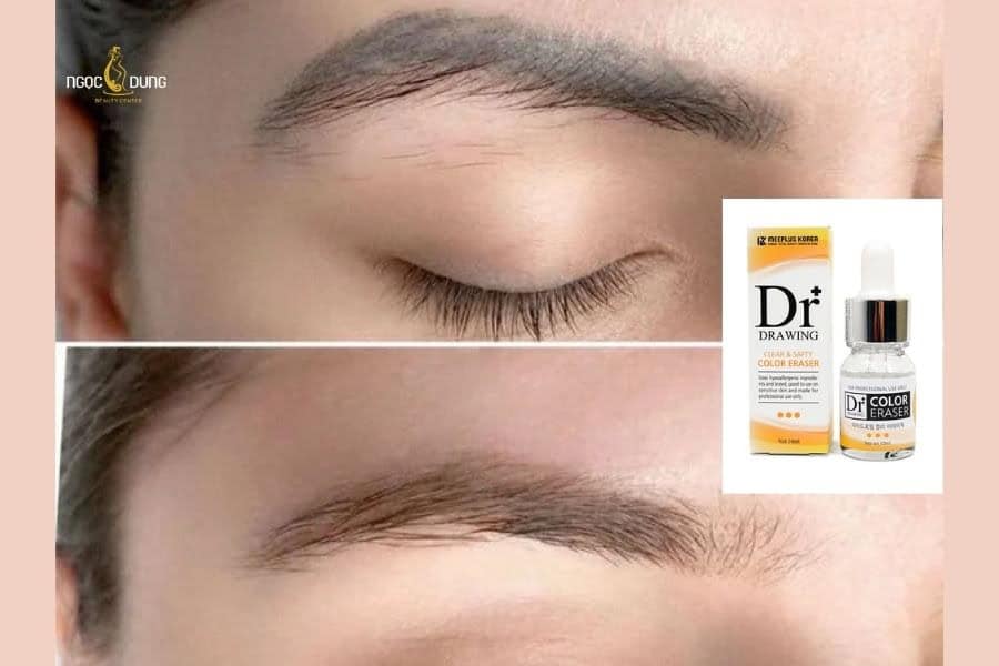 Xóa xăm chân mày có để lại sẹo không? Lợi ích và rủi ro 6 Dùng hóa chất có thể xóa xăm chân mày ở các trường hợp mực nông