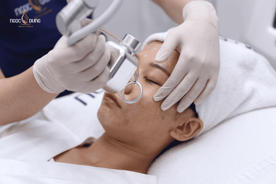 IPL là giải pháp tối ưu cho làn da tổn thương sau mụn