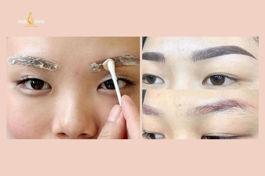Xóa xăm chân mày có để lại sẹo không? Lợi ích và rủi ro 7 Kem xóa xăm chân mày chỉ có thể làm mờ nhẹ vết mực phun